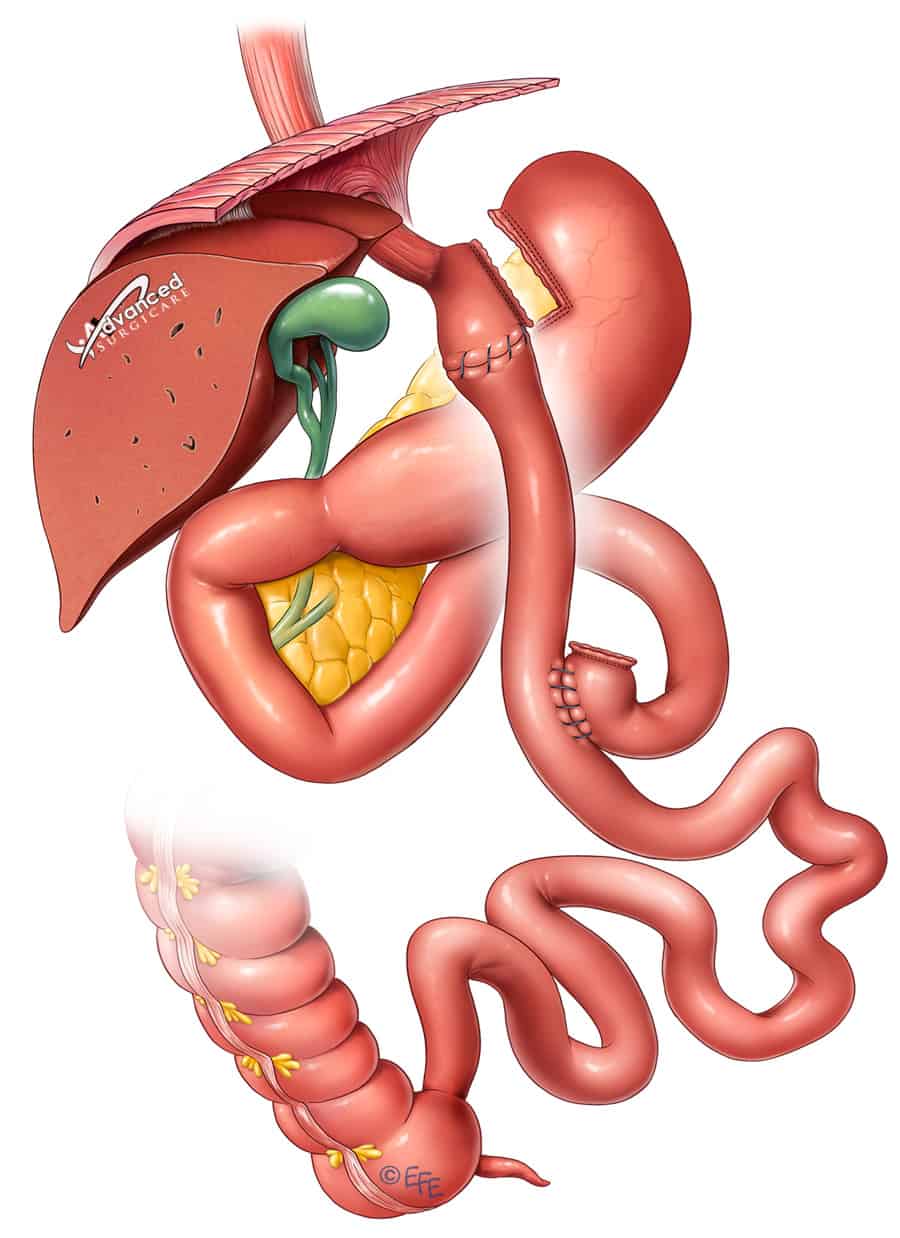 Gastric-bypass