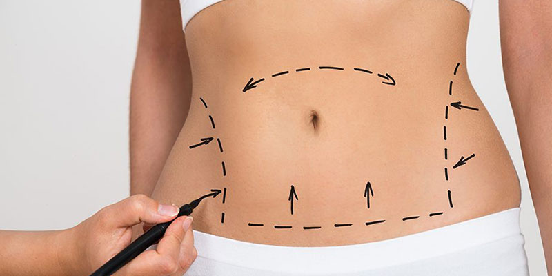 abdominoplasty