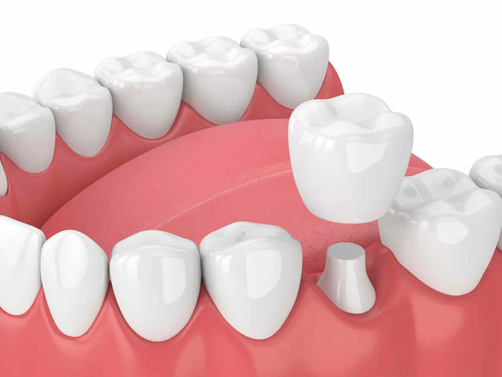 dental_crowns