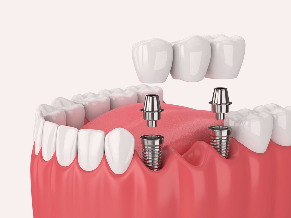 dental_implants