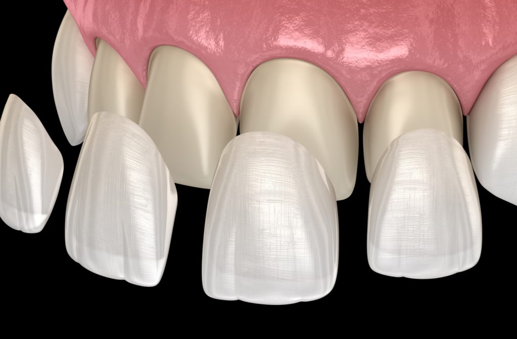 dental_veneers