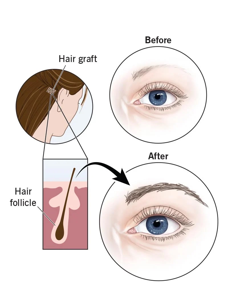 eyebrowtransplant