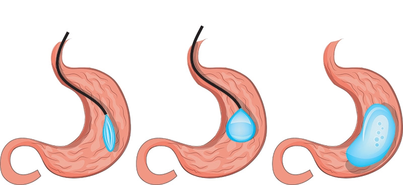 gastric-balloon